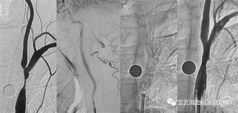 锁骨下动脉盗血综合征 脑医汇 神外资讯 神介资讯