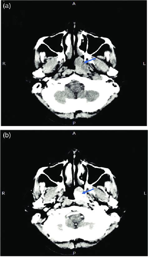 Follicular Dendritic Cell Sarcoma Of The Nasopharynx A On