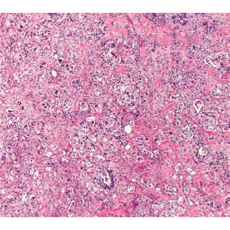 H E Stained Sections Demonstrating Focal Chronic Active Colitis