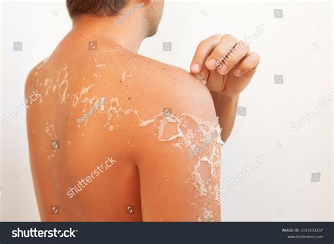 Sunburn Peeling