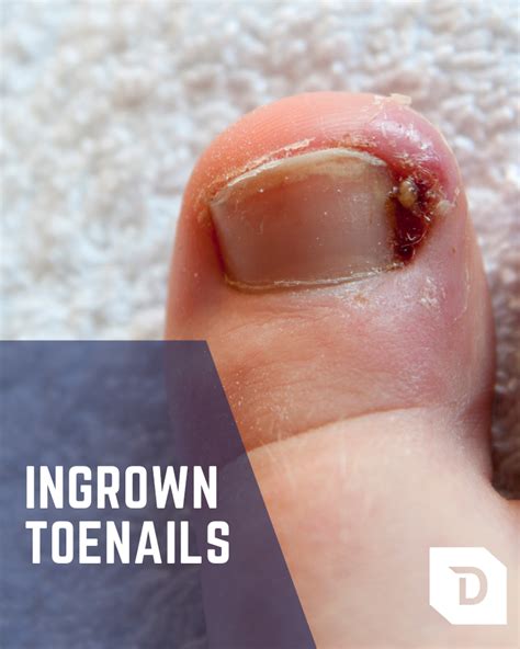 Ingrown Toenails Plantecuador