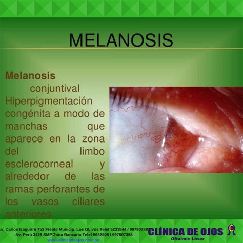 Cl Nica De Ojos Oftalmic L Ser Melanosis