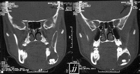 Radioogle Ent Mandibular Cyst 4