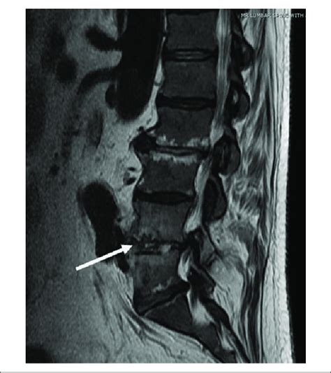 Magnetic Resonance Imaging Discitis Osteomyelitis At L L With