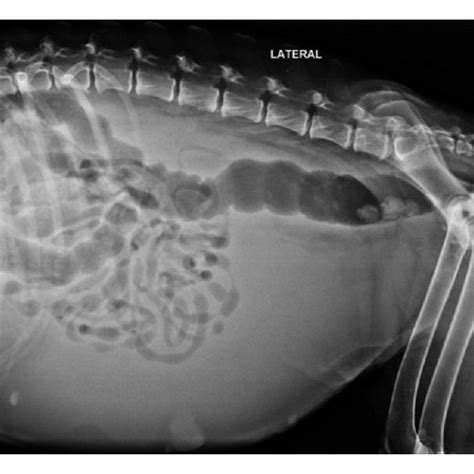 X Ray Of Abdomen Showing Ground Glass Appearance Indicating Free Fluid