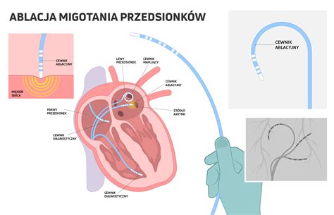 Ablacja Serca Szpital Ywiec