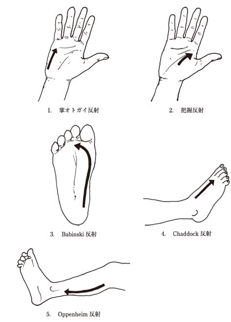 手掌おとがい反射 Palmomental Reflex Japaneseclassjp