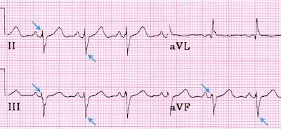 Study Medical Photos: Left Anterior Fascicular Block - ECG