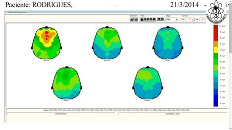 Eletroencefalograma mapeamento cerebral como é feito