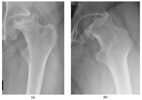 J Compos Sci Free Full Text Outcomes Of Ceramic Composite In Total Hip Replacement