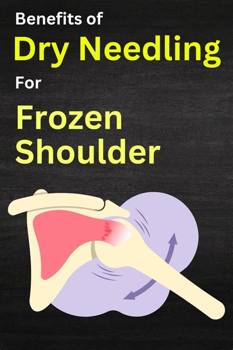 Benefits Of Dry Needling For Frozen Shoulder Dry Needling Frozen Shoulder Dry Needling Therapy