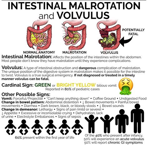 Volvulus Malrotation