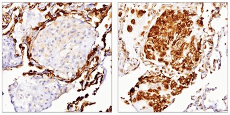 Hemangioma Basicmedical Key