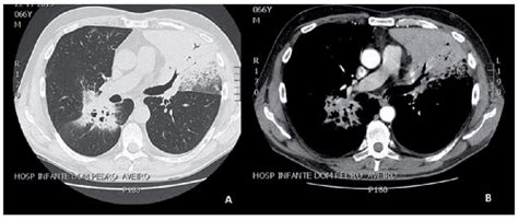 Thoracic Computed Tomography Axial View Pulmonary Consolidation With Download Scientific