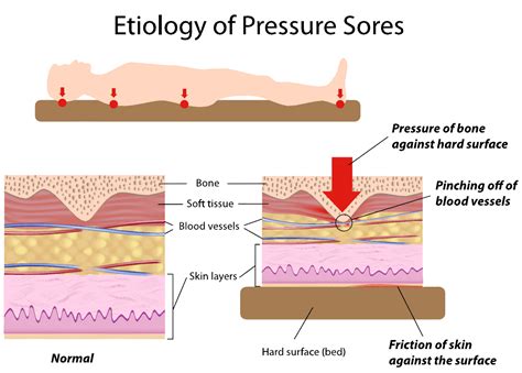 Bed Sores Should Never Happen - Pennsylvania Nursing Home Abuse Lawyers ...