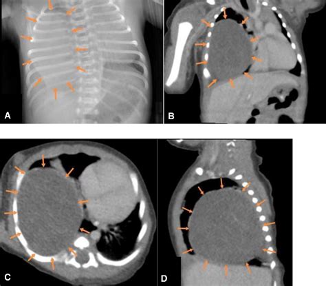 Figure From A Case Report Of Misdiagnosed Fetal Lung Mass And Review