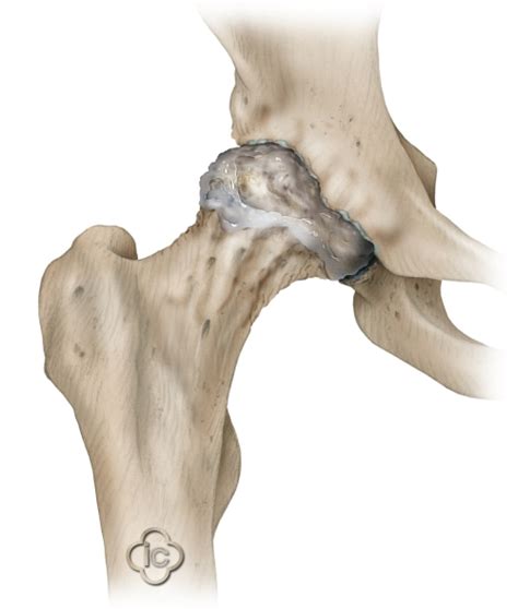 Total Hip Replacement Surgery (Hip Prosthesis) | Joint-surgeon.com