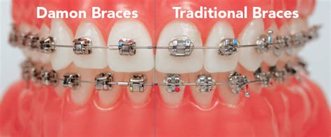 Damon Braces Braces Explained