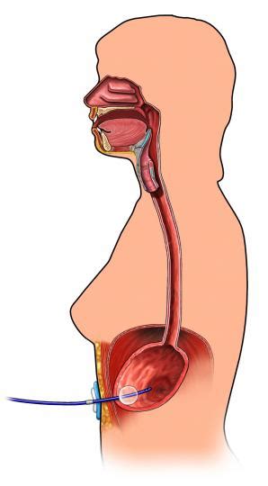 Cuidados de las Sonda Gastrostomía Instituto Quirúrgico de Andalucía IQA