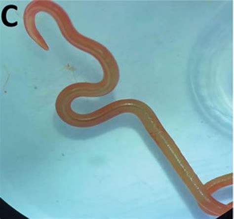 Surgeon Finds Live 3-Inch Worm in Woman’s Brain in World First