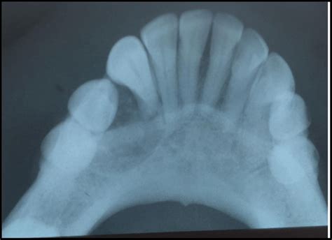 Fig Occlusal Radiograph Showing Well Defined Radiolucency In The