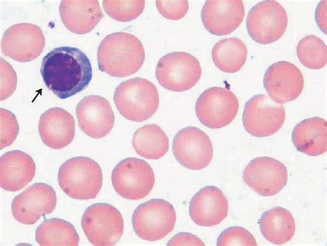 有核红细胞 实验诊断学图谱 医学