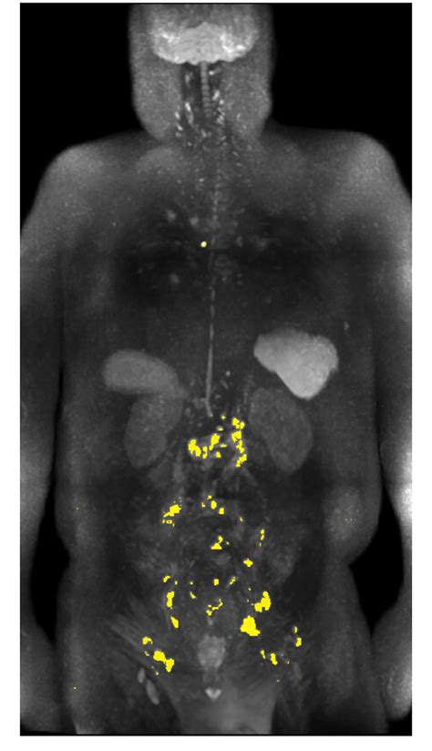 Whole Body Diffusion Weighted Imaging Wb Dwi For A 66 Year Old