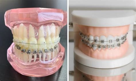 Video Ceramic Braces Vs Metal Braces Cost Pros And Cons Pictures Faqs