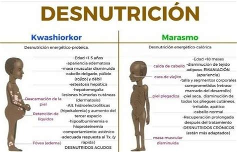 Desnutrición Infantil Pediatría