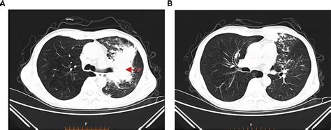 Frontiers Tuberculosis Infection Following Immune Checkpoint Inhibitor Treatment For Advanced