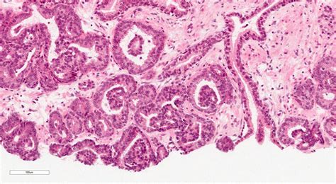 Prostate Cancer Pathology