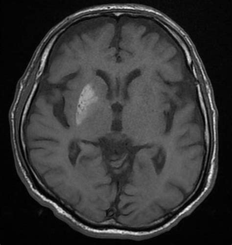 Diabetic Striatopathy Bmj Case Reports