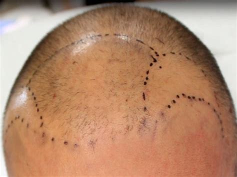 Fue Hair Transplant Testimonial 2 001 Hair Transplants Tijuana Mexico Clinic