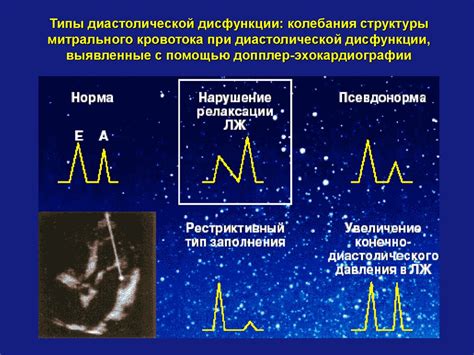Диастолическая дисфункция левого желудочка 1 типа - что это такое и как ...