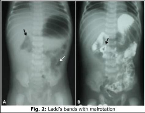 (A). Plain X-ray Erect Abdomen shows dilated gas filled stomach and ...