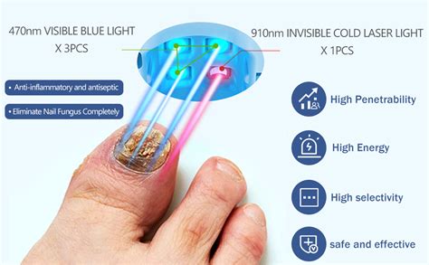 Ikeener Nail Fungus Light Treatment Device For Toenail Toe Nail Fungus