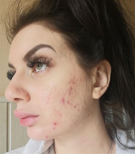 Help I Am On Roaccutane For 6 Months This Month Breakout Skin I Had