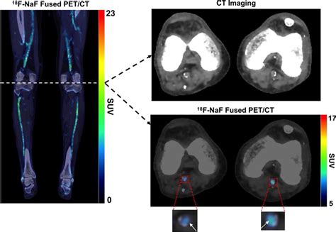 Representative ¹⁸F NaF PET CT imaging of the lower extremities in a