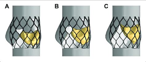 Structural Model After Valve Stent Intervention A Valve Stent Download Scientific Diagram