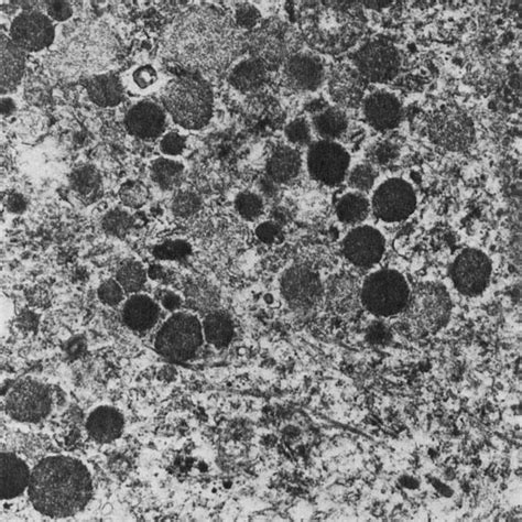 typical apocrine cells layering  surface   small cyst