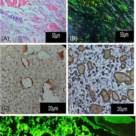 Calcifying epithelial odontogenic tumor (Pindborg tumor),... | Download ...