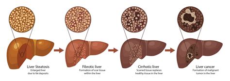 Nonalcoholic Steatohepatitis Identifying High Risk Patients