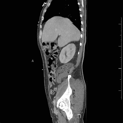 Gluteal Abscess Ultrasound