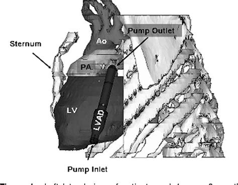 Figure From Pediatric Mechanical Circulatory Support The Cleveland