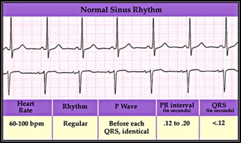 Ekg Midterm Flashcards Quizlet