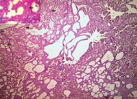 Acquired Cystic Kidney Disease Associated Renal Cell Carcinoma: A Case ...