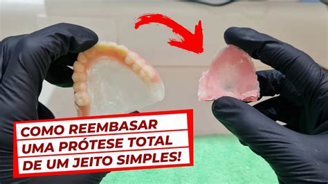 COMO REEMBASAR UMA PRÓTESE TOTAL DE UM JEITO SIMPLES Prótese Dentária