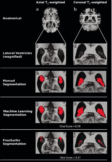 Figure 3 From Deep Learning Segmentation Of The Choroid Plexus From