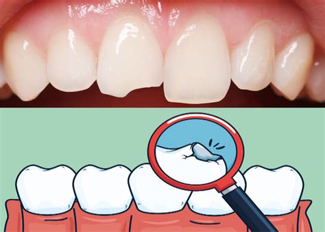 Chipped Tooth Repair Molar