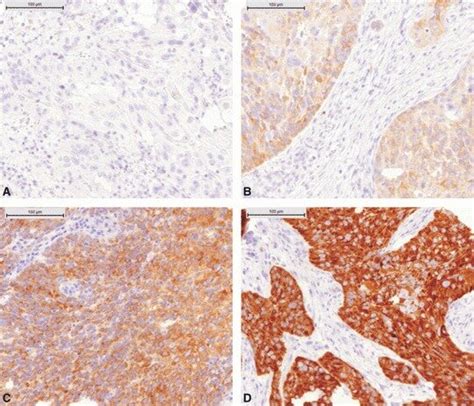 Immunohistochemical Staining For Insulin Like Growth Factor Ii